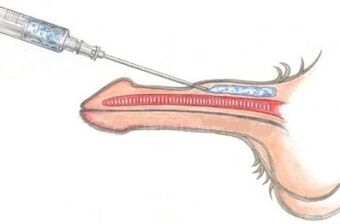 Eine gefährliche Methode zur Penisvergrößerung mittels Vaseline-Injektionen